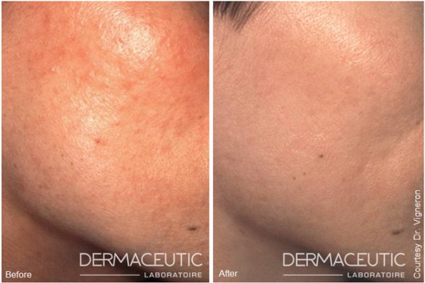 Dermaceutic-MASK-PEEL-2 (1)