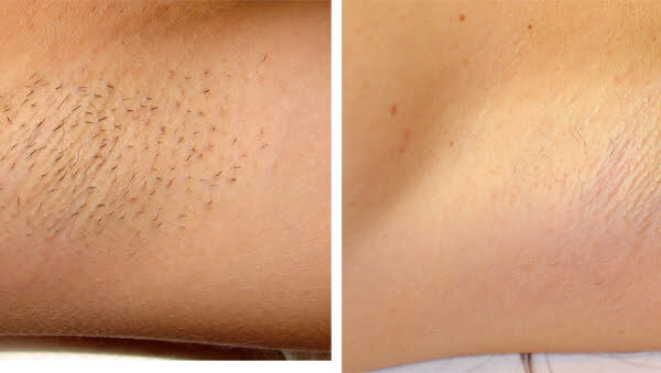 M22
axilla/hair removal
BEFORE / AFTER  6x