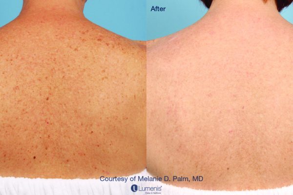 Stellar-M22_IPL_Skin-rejuvenation_Palm-2_3m2t